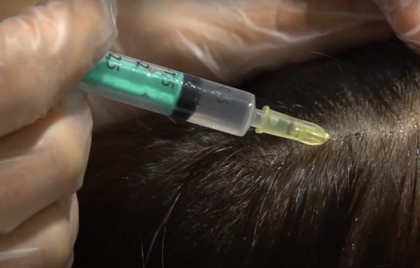 Мезотерапия волосистой кожи головы